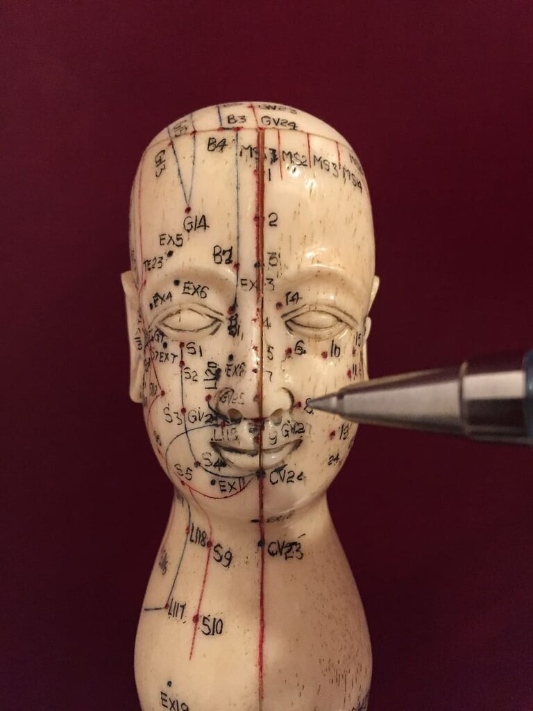 acupuncture pressure points- acupuncture for sinus
