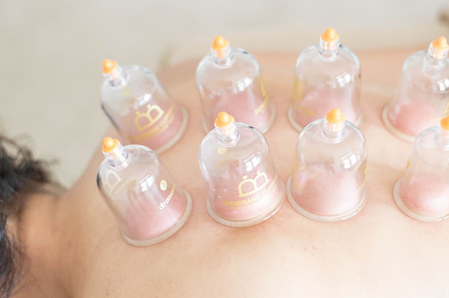 cupping and accupuncture for sinus relief