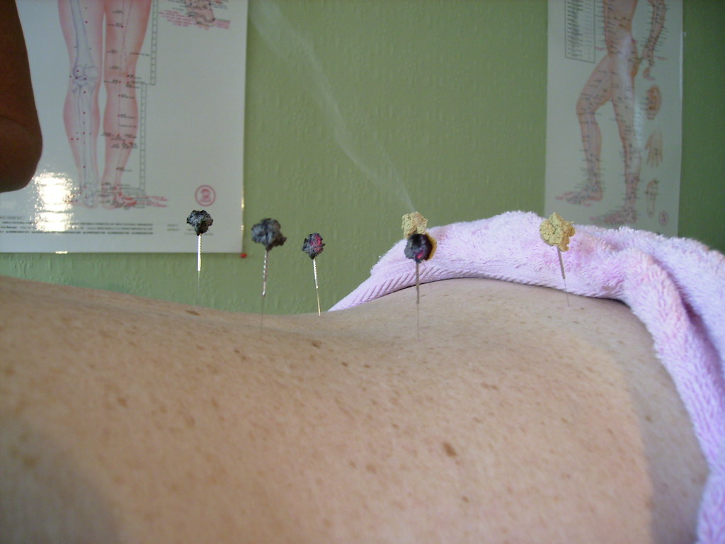 moxibustion acupuncture for sinus infection
