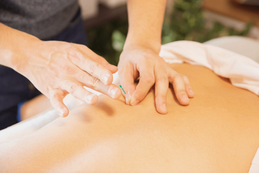 acupuncture, a type of holistic functional medicine