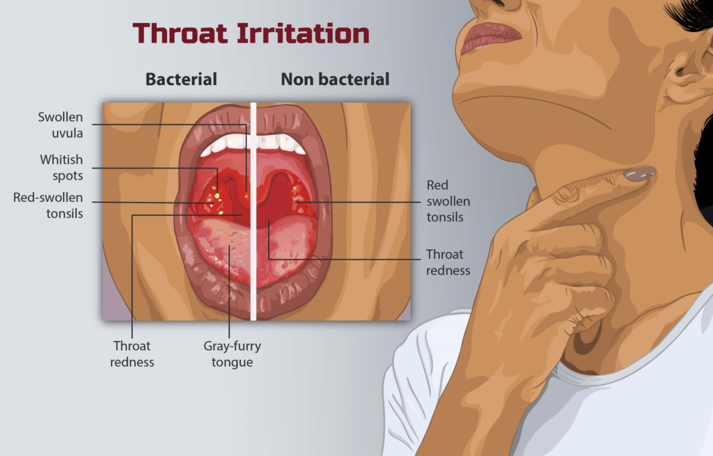 throat irritation- how to use apple cider vinegar for UTI